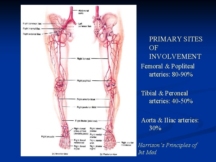 PRIMARY SITES OF INVOLVEMENT Femoral & Popliteal arteries: 80 -90% Tibial & Peroneal arteries: