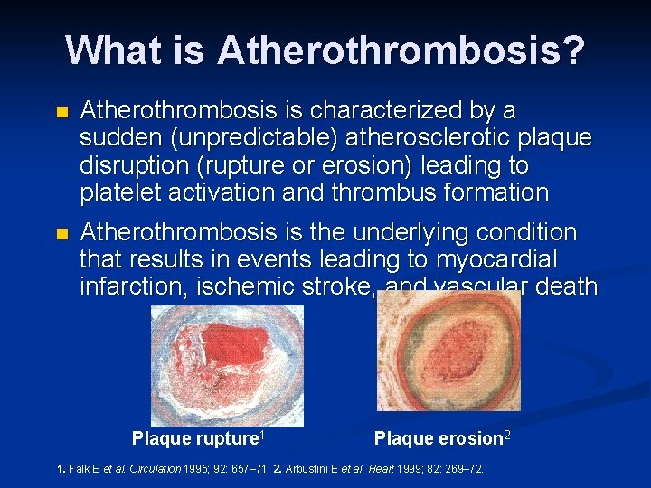 What is Atherothrombosis? n Atherothrombosis is characterized by a sudden (unpredictable) atherosclerotic plaque disruption