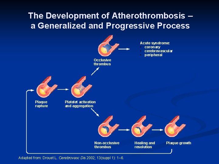 The Development of Atherothrombosis – a Generalized and Progressive Process Acute syndrome: • coronary