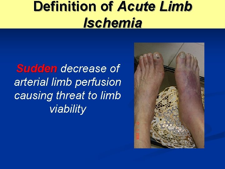 Definition of Acute Limb Ischemia Sudden decrease of arterial limb perfusion causing threat to