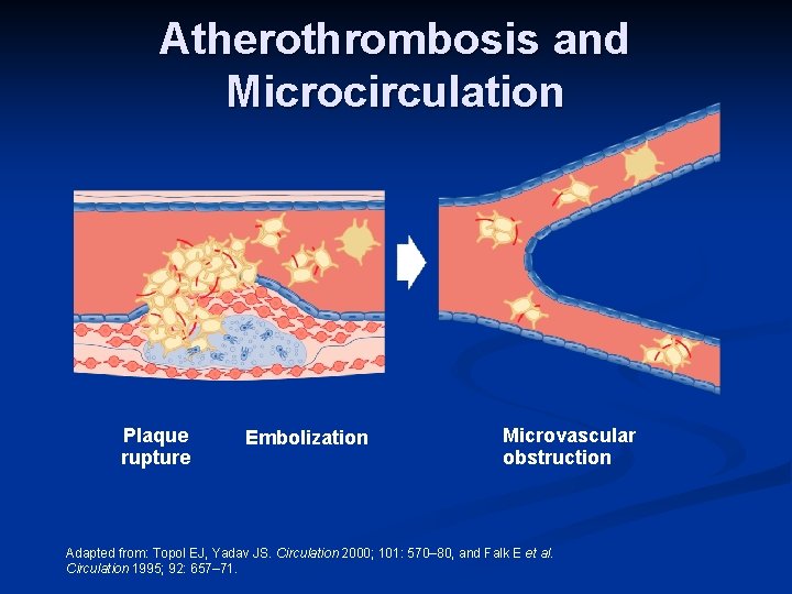 Atherothrombosis and Microcirculation Plaque rupture Embolization Microvascular obstruction Adapted from: Topol EJ, Yadav JS.