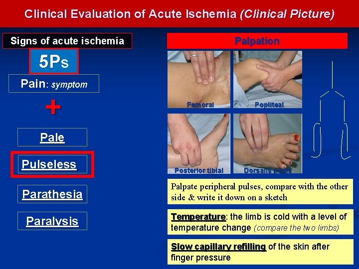 Clinical Evaluation of Acute Ischemia (Clinical Picture) Signs of acute ischemia Palpation 5 Ps