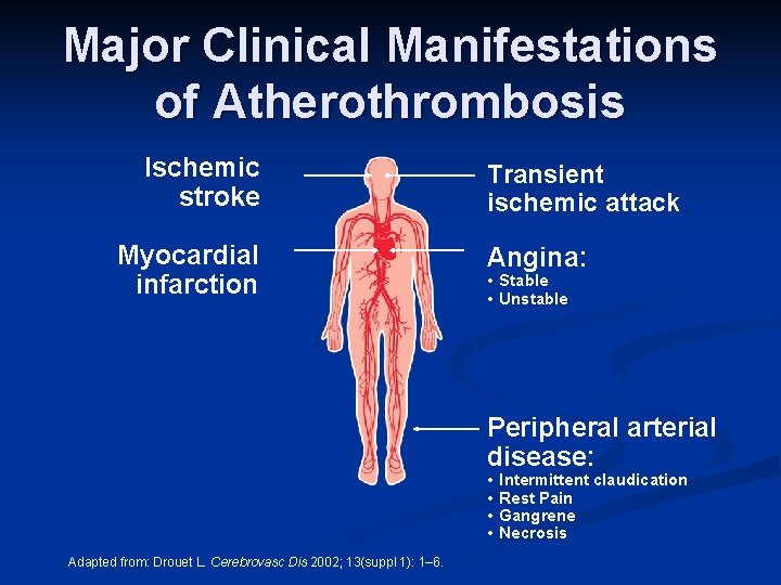 Major Clinical Manifestations of Atherothrombosis Ischemic stroke Myocardial infarction Transient ischemic attack Angina: •