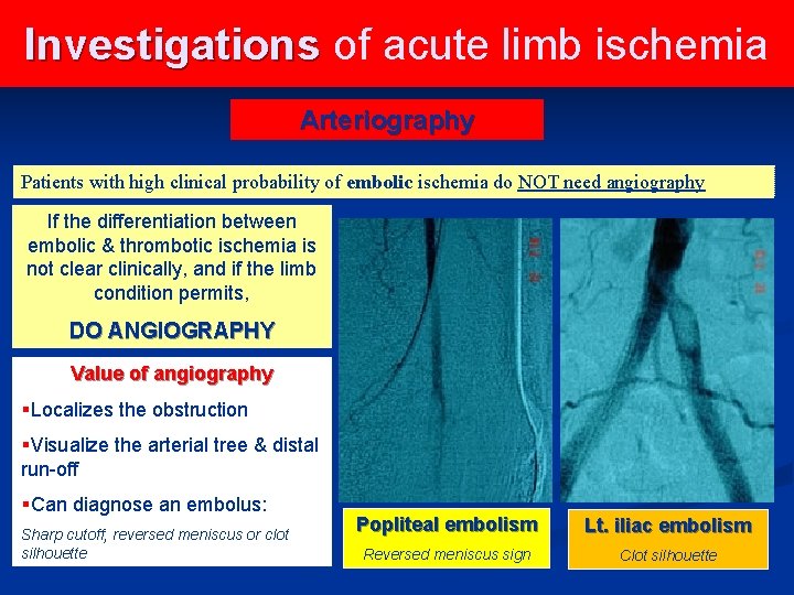 Investigations of acute limb ischemia Arteriography Patients with high clinical probability of embolic ischemia