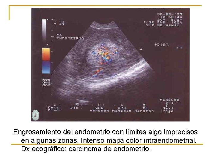 Engrosamiento del endometrio con límites algo imprecisos en algunas zonas. Intenso mapa color intraendometrial.