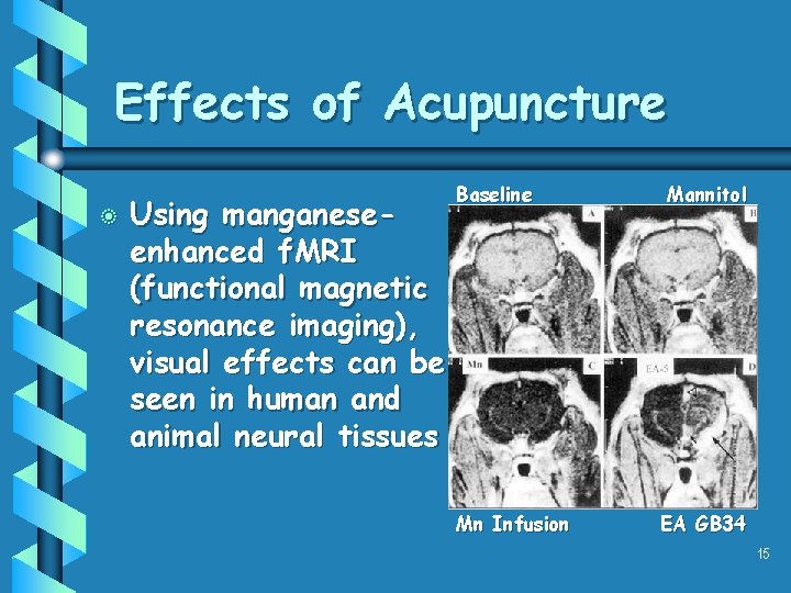 Effects of Acupuncture b Using manganeseenhanced f. MRI (functional magnetic resonance imaging), visual effects