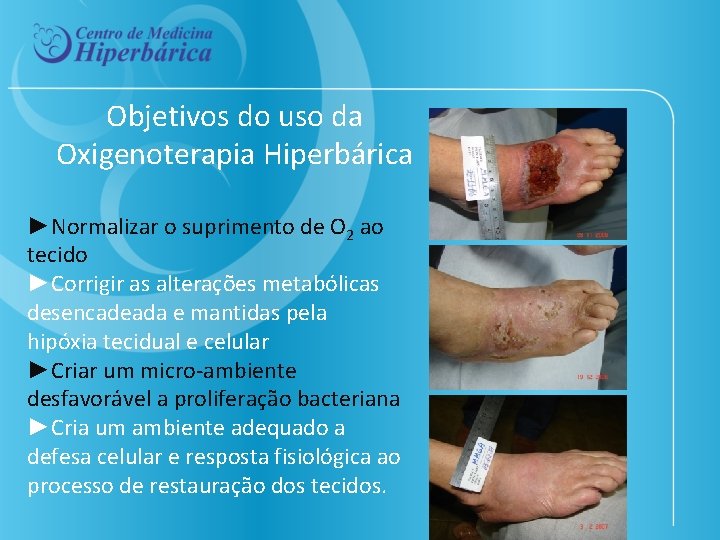 Objetivos do uso da Oxigenoterapia Hiperbárica ►Normalizar o suprimento de O 2 ao tecido