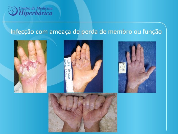 Infecção com ameaça de perda de membro ou função 