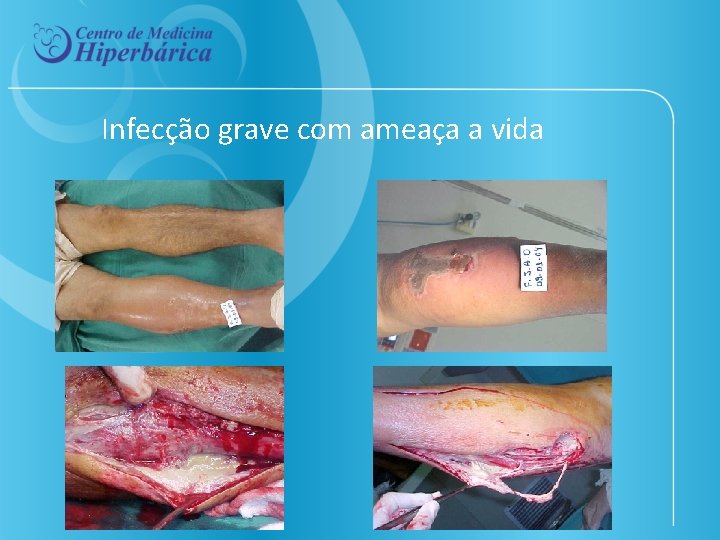 Infecção grave com ameaça a vida 