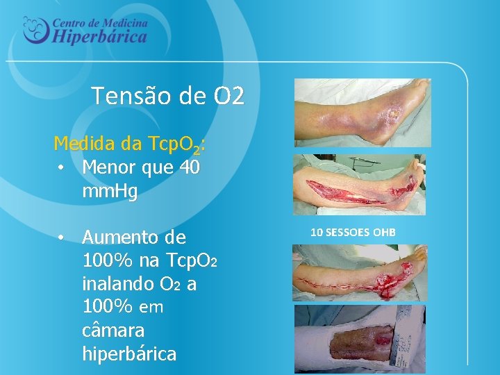 Tensão de O 2 Medida da Tcp. O 2: • Menor que 40 mm.