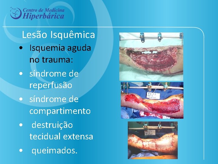 Lesão Isquêmica • Isquemia aguda no trauma: • síndrome de reperfusão • síndrome de