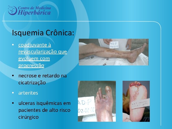 Isquemia Crônica: • coadjuvante à revascularização que evoluem com progressão • necrose e retardo