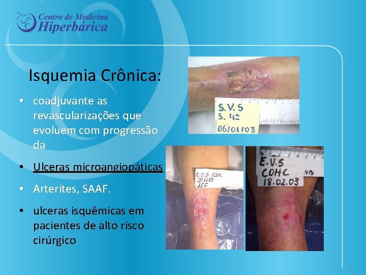 Isquemia Crônica: • coadjuvante as revascularizações que evoluem com progressão da • Ulceras microangiopáticas