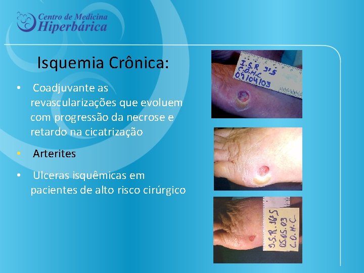 Isquemia Crônica: • Coadjuvante as revascularizações que evoluem com progressão da necrose e retardo