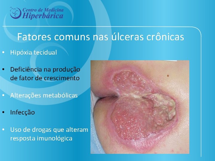 Fatores comuns nas úlceras crônicas • Hipóxia tecidual • Deficiência na produção de fator