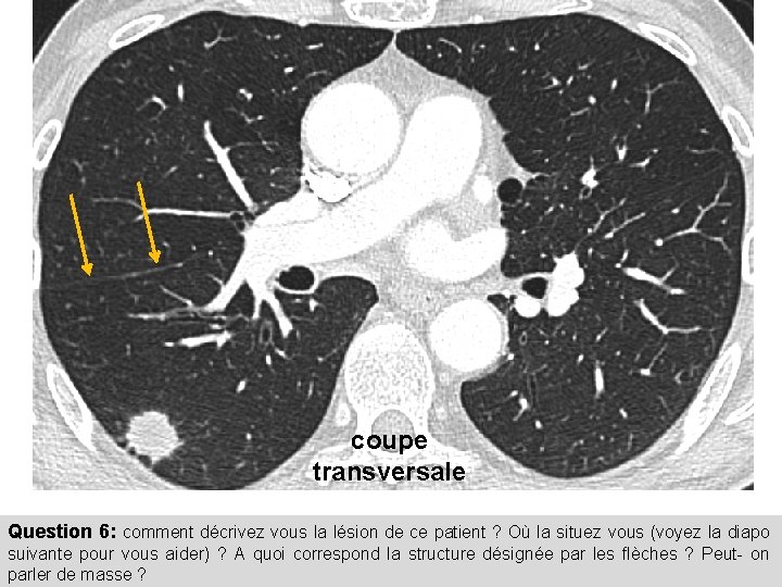 coupe transversale Question 6: comment décrivez vous la lésion de ce patient ? Où