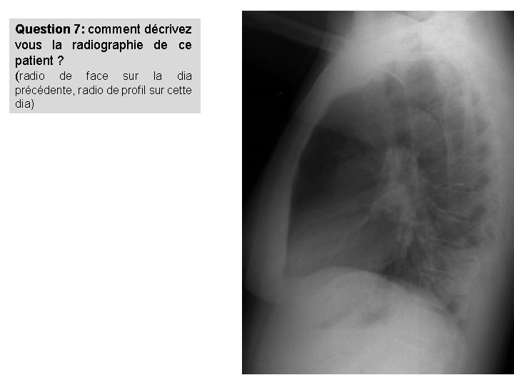 Question 7: comment décrivez vous la radiographie de ce patient ? (radio de face