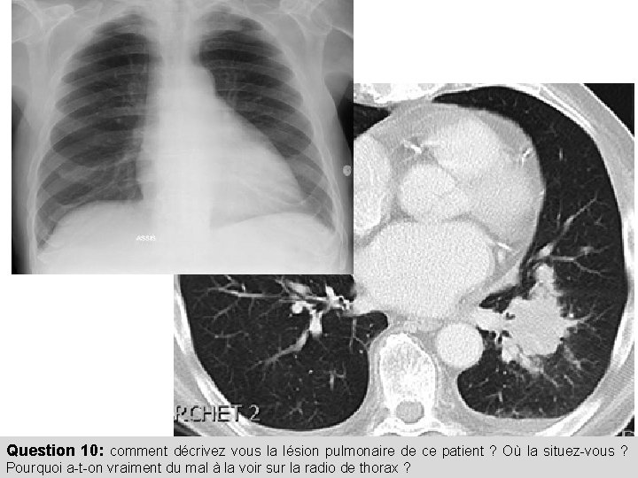 Question 10: comment décrivez vous la lésion pulmonaire de ce patient ? Où la