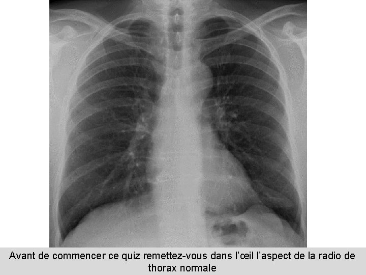 Avant de commencer ce quiz remettez-vous dans l’œil l’aspect de la radio de thorax