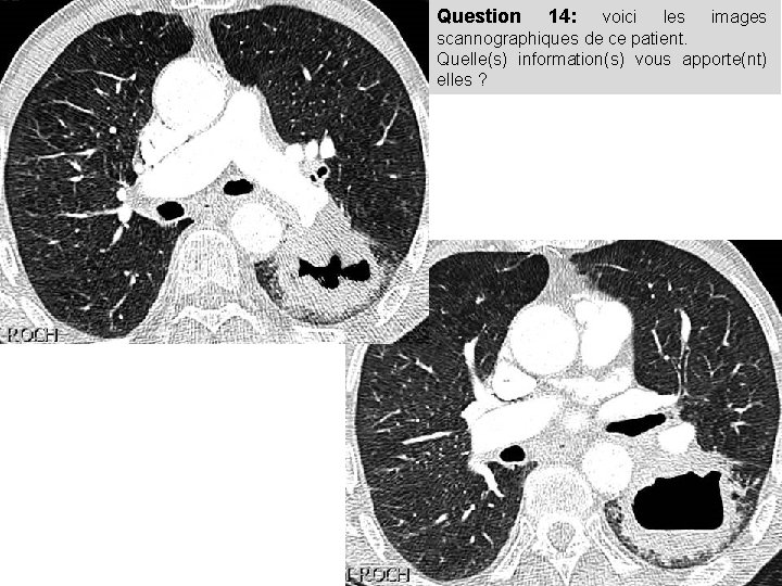 Question 14: voici les images scannographiques de ce patient. Quelle(s) information(s) vous apporte(nt) elles