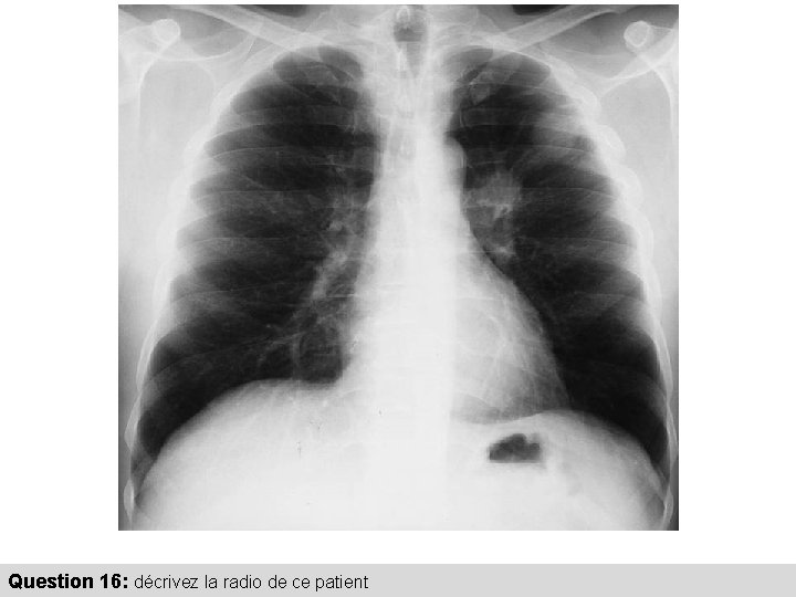 Question 16: décrivez la radio de ce patient 
