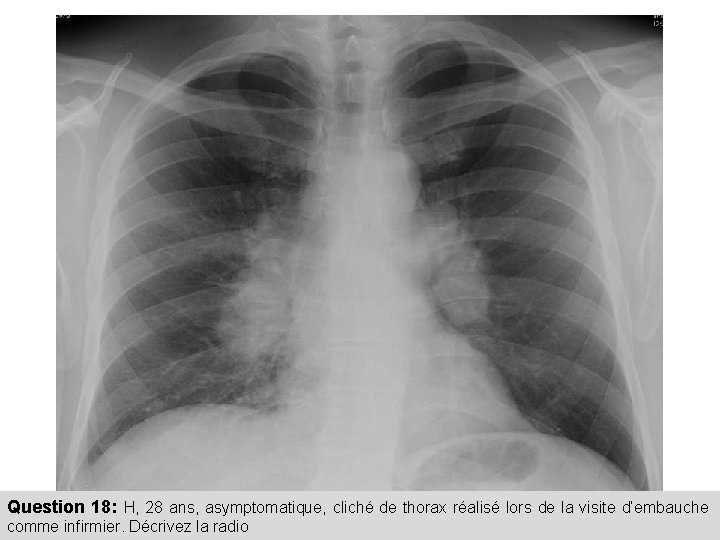 Question 18: H, 28 ans, asymptomatique, cliché de thorax réalisé lors de la visite