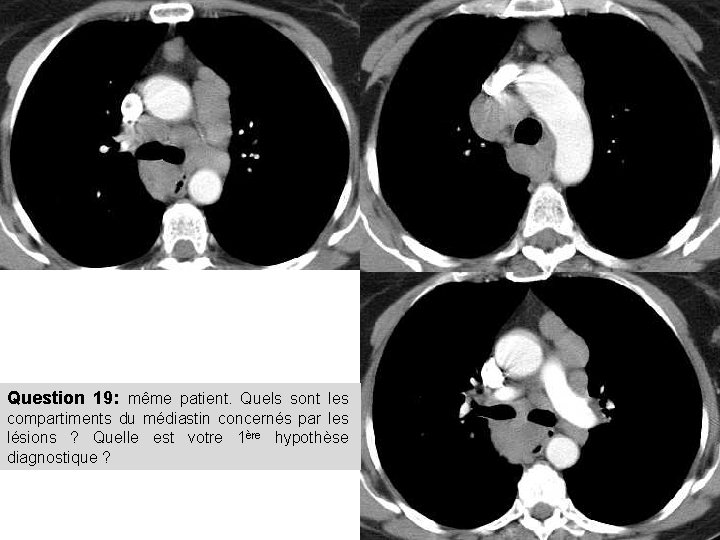 Question 19: même patient. Quels sont les compartiments du médiastin concernés par les lésions