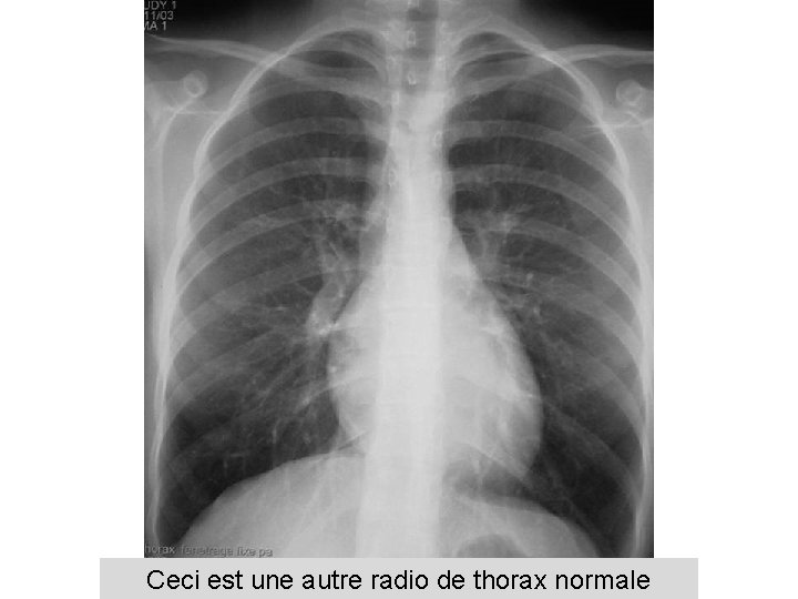 Ceci est une autre radio de thorax normale 