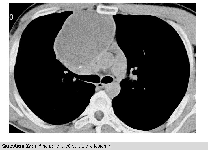 Question 27: même patient, où se situe la lésion ? 