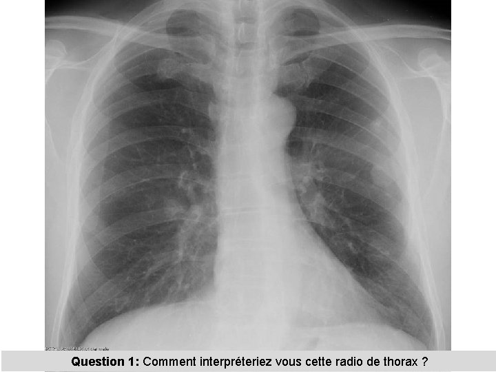 Question 1: Comment interpréteriez vous cette radio de thorax ? 