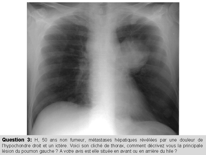 Question 3: H, 50 ans non fumeur, métastases hépatiques révélées par une douleur de