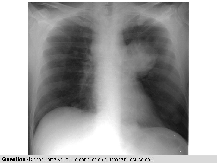 Question 4: considérez vous que cette lésion pulmonaire est isolée ? 