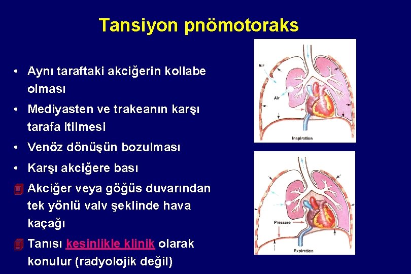 Tansiyon pnömotoraks • Aynı taraftaki akciğerin kollabe olması • Mediyasten ve trakeanın karşı tarafa