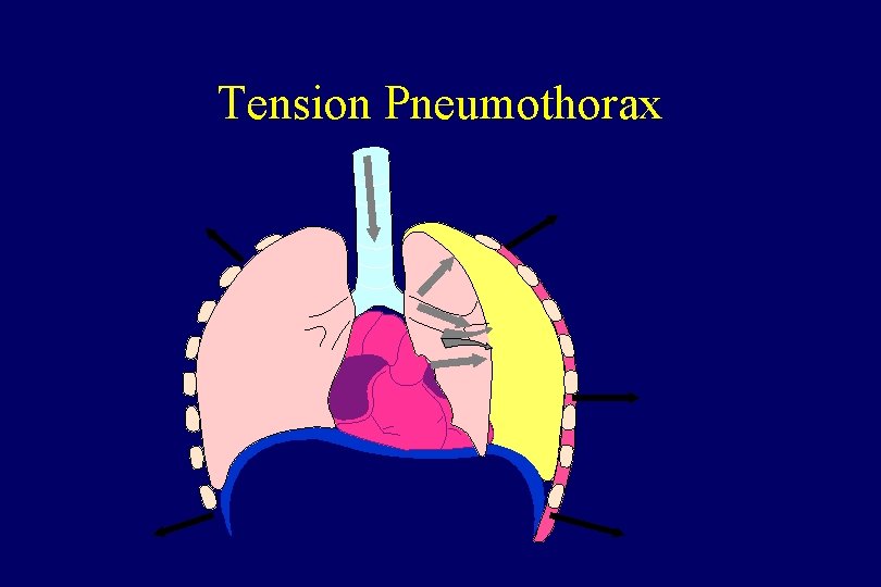 Tension Pneumothorax 