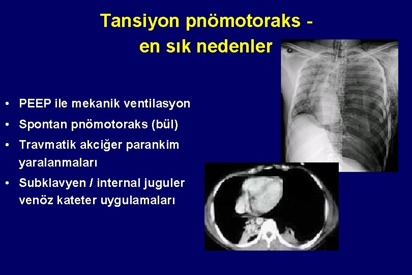 Tansiyon pnömotoraks en sık nedenler • PEEP ile mekanik ventilasyon • Spontan pnömotoraks (bül)