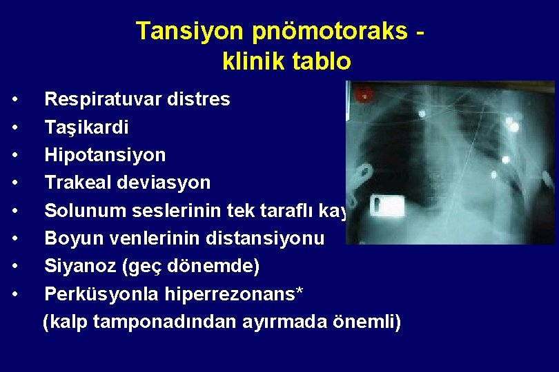 Tansiyon pnömotoraks klinik tablo • • Respiratuvar distres Taşikardi Hipotansiyon Trakeal deviasyon Solunum seslerinin Tansiyon pnömotoraks klinik tablo • • Respiratuvar distres Taşikardi Hipotansiyon Trakeal deviasyon Solunum seslerinin