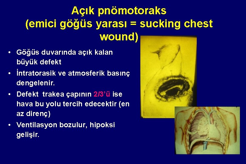 Açık pnömotoraks (emici göğüs yarası = sucking chest wound) • Göğüs duvarında açık kalan