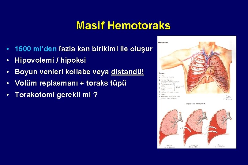 Masif Hemotoraks • 1500 ml’den fazla kan birikimi ile oluşur • Hipovolemi / hipoksi