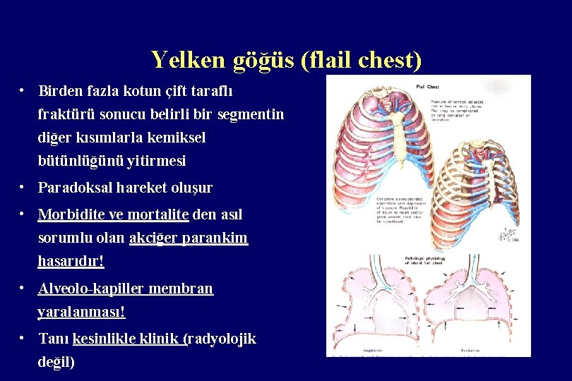 Yelken göğüs (flail chest) • Birden fazla kotun çift taraflı fraktürü sonucu belirli bir