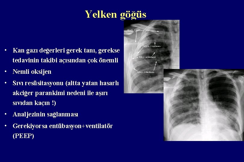 Yelken göğüs • Kan gazı değerleri gerek tanı, gerekse tedavinin takibi açısından çok önemli