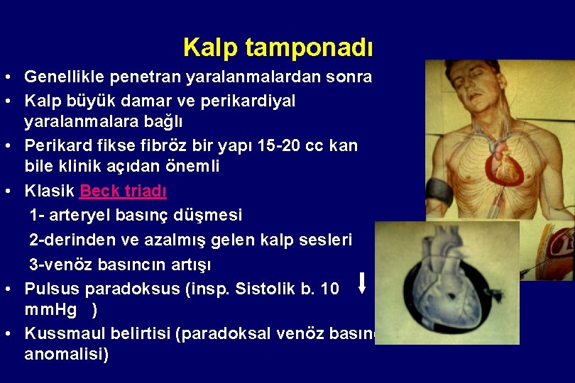 Kalp tamponadı • Genellikle penetran yaralanmalardan sonra • Kalp büyük damar ve perikardiyal yaralanmalara Kalp tamponadı • Genellikle penetran yaralanmalardan sonra • Kalp büyük damar ve perikardiyal yaralanmalara