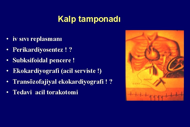 Kalp tamponadı • iv sıvı replasmanı • Perikardiyosentez ! ? • Subksifoidal pencere ! Kalp tamponadı • iv sıvı replasmanı • Perikardiyosentez ! ? • Subksifoidal pencere !