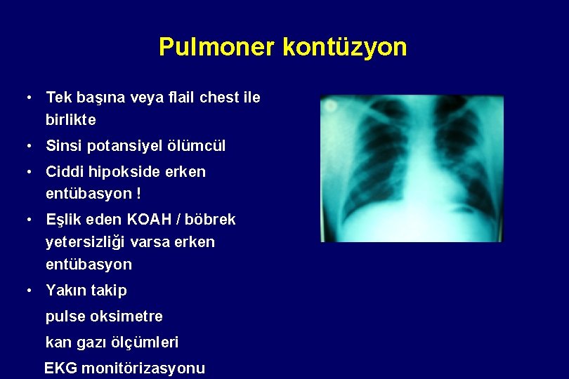 Pulmoner kontüzyon • Tek başına veya flail chest ile birlikte • Sinsi potansiyel ölümcül