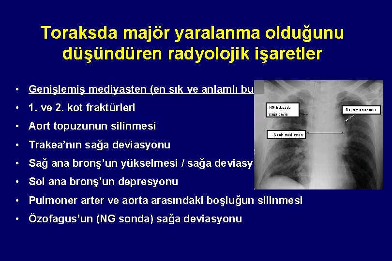 Toraksda majör yaralanma olduğunu düşündüren radyolojik işaretler • Genişlemiş mediyasten (en sık ve anlamlı