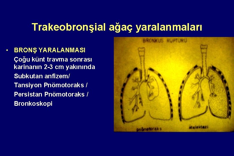 Trakeobronşial ağaç yaralanmaları • BRONŞ YARALANMASI Çoğu künt travma sonrası karinanın 2 -3 cm