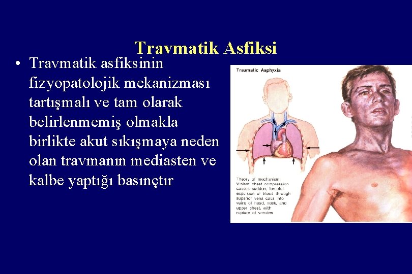 Travmatik Asfiksi • Travmatik asfiksinin fizyopatolojik mekanizması tartışmalı ve tam olarak belirlenmemiş olmakla birlikte