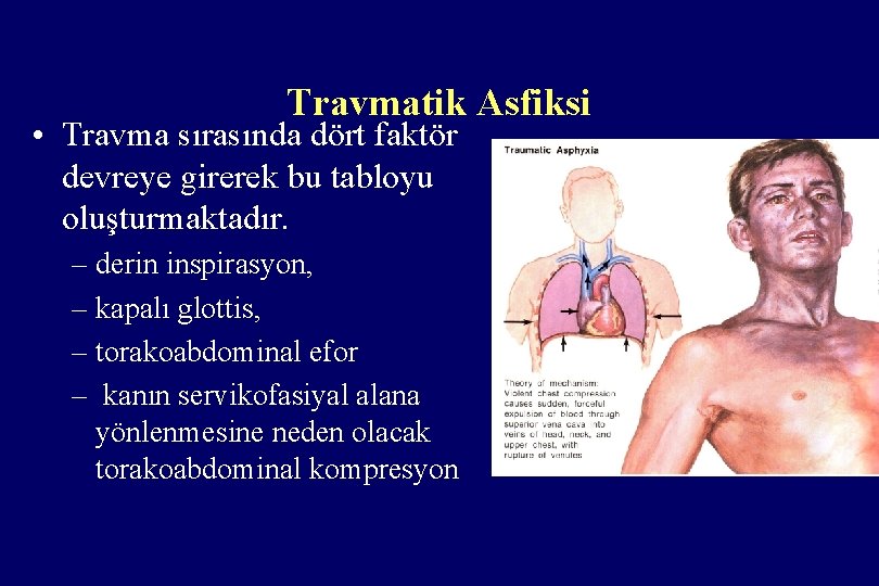 Travmatik Asfiksi • Travma sırasında dört faktör devreye girerek bu tabloyu oluşturmaktadır. – derin