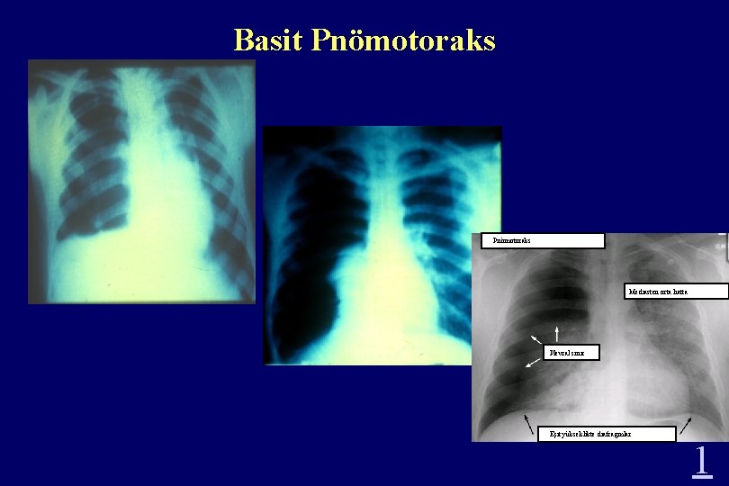 Basit Pnömotoraks Mediasten orta hatta Plevral sınır Eşit yükseklikte diafragmlar 1 