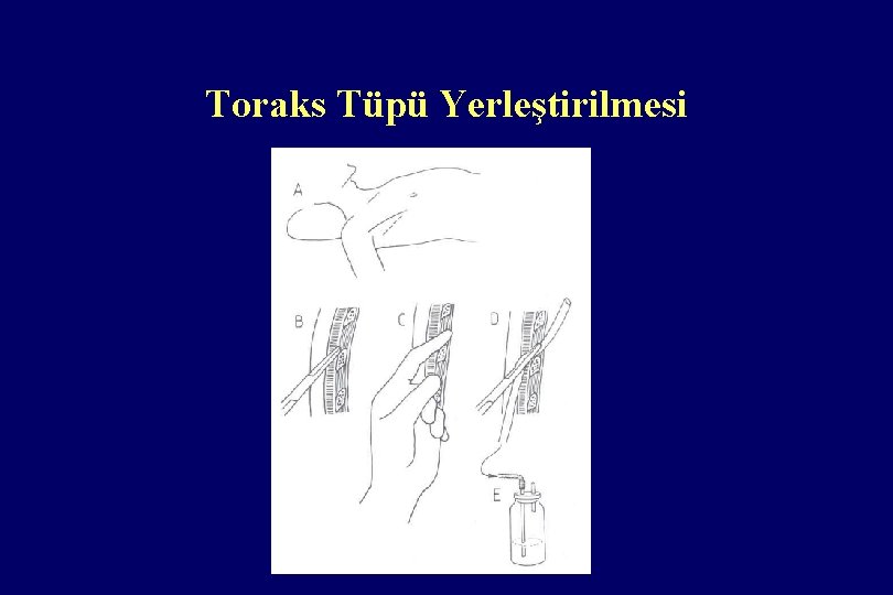 Toraks Tüpü Yerleştirilmesi 