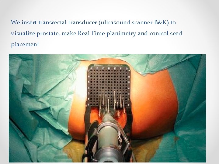 We insert transrectal transducer (ultrasound scanner B&K) to visualize prostate, make Real Time planimetry